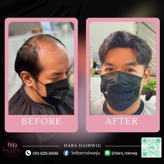 วิกติดกาว ราคา - ร้านวิกผมติดกาว ช่างองุ่น - Dara Hairwig